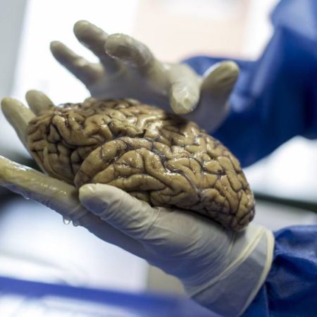 Descubierto el segundo caso de una persona resistente al alzhéimer | Ciencia